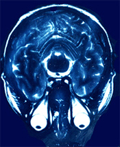 CAT Scan of Joe's brain